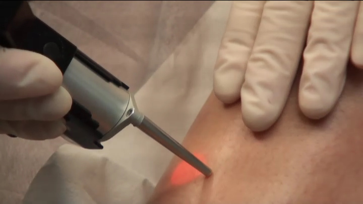 epilation-laser-savoir-faire