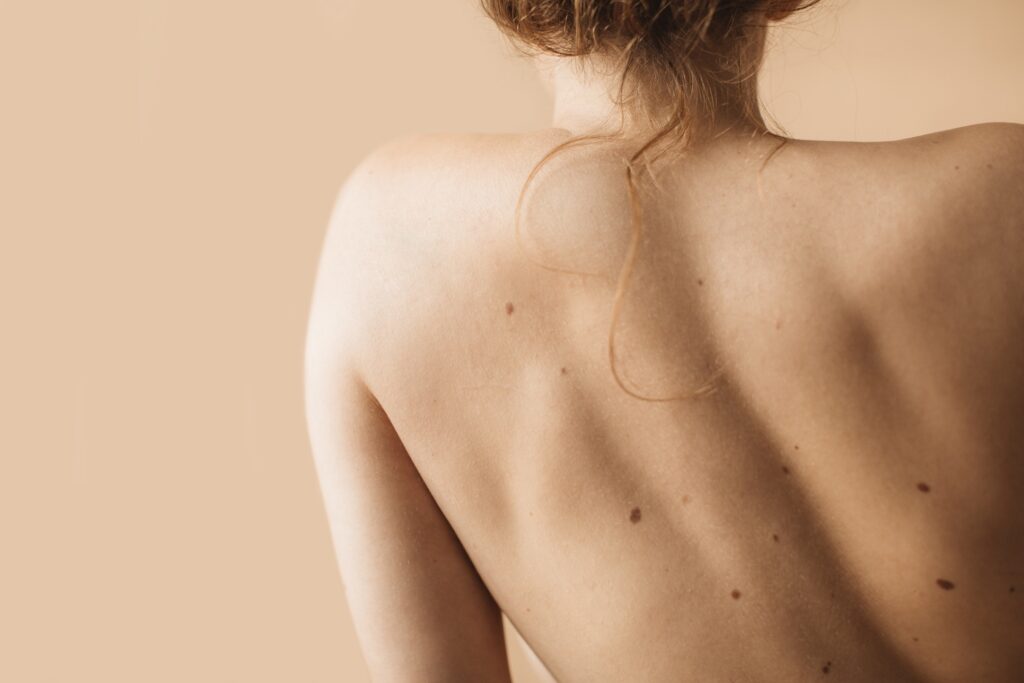 tache cutanée, dermatologue spécialiste taches pigmentation paris, taches sur la peau, tâches pigmentaires traitement