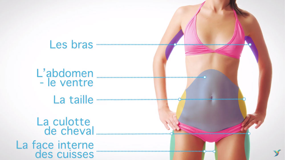 Centre-Marceau-les-zones-transformables-par-Cryolipolyse