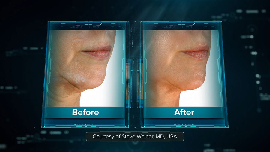Centre-Marceau-Peeling-Laser-Genius-04 rajeunissement visage naturel - Centre-Marceau-Peeling-Laser-Genius-04