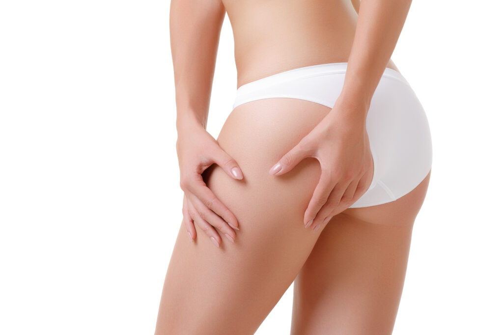 Checking cellulite woman hip close up traitement cellulite