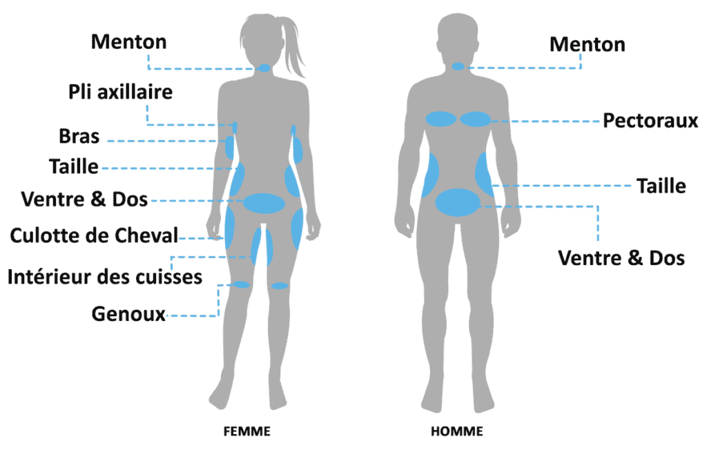coolsculpting - Cryo-zones - Bordeaux - cryolipolyse
